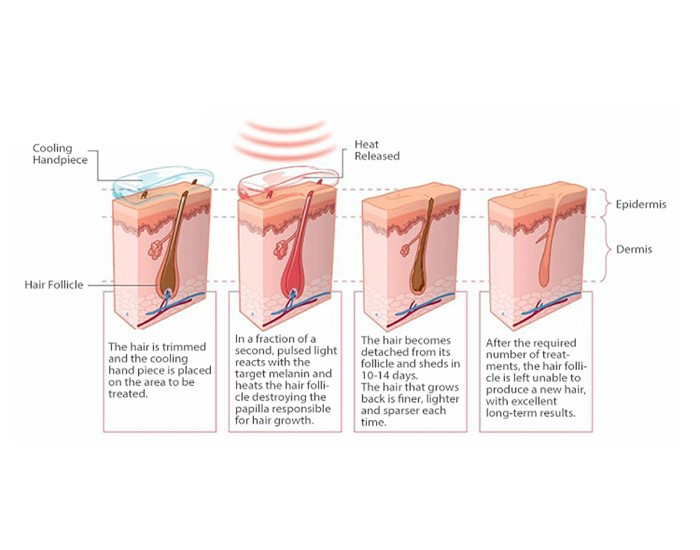laser hair removal and skin rejuvenation machine laser hair removal and skin rejuvenation machine