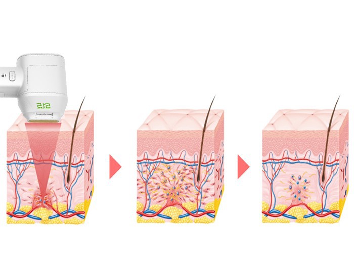 hifu body sculpting machine hifu body sculpting machine