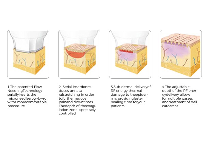 Newangie hifu 12d machine Newangie hifu 12d machine