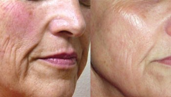 Який найефективніший лазер для старіння шкіри?