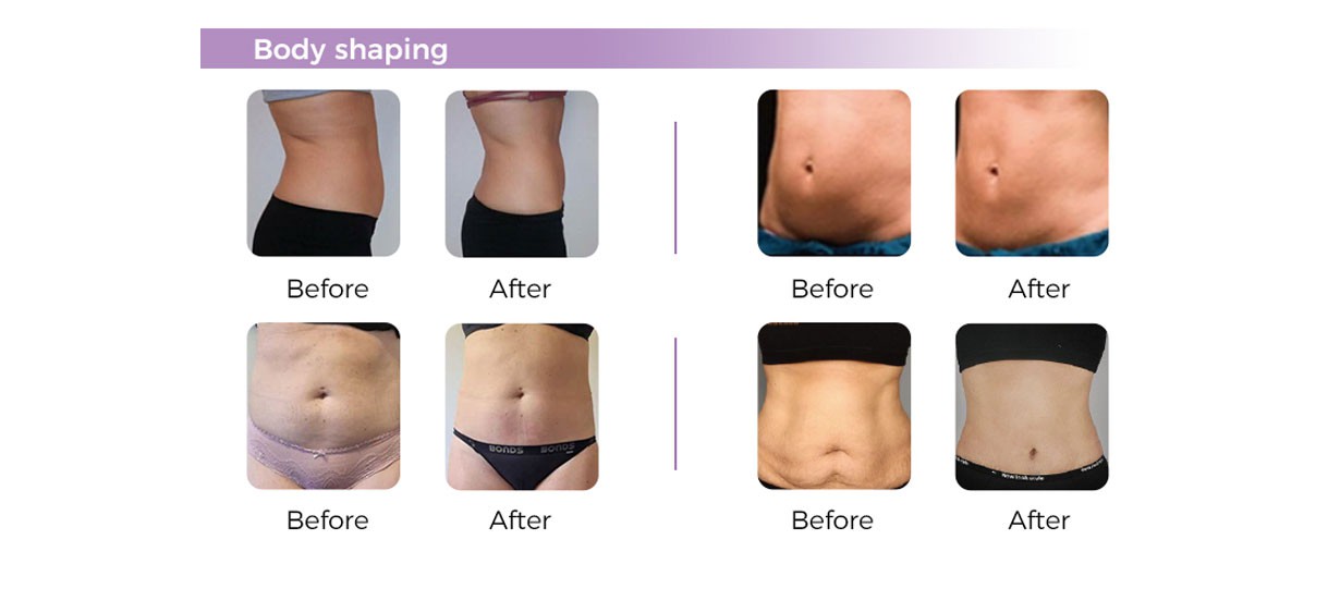 new 12d hifu Face And Body Lifting Machine new 12d hifu Face And Body Lifting Machine